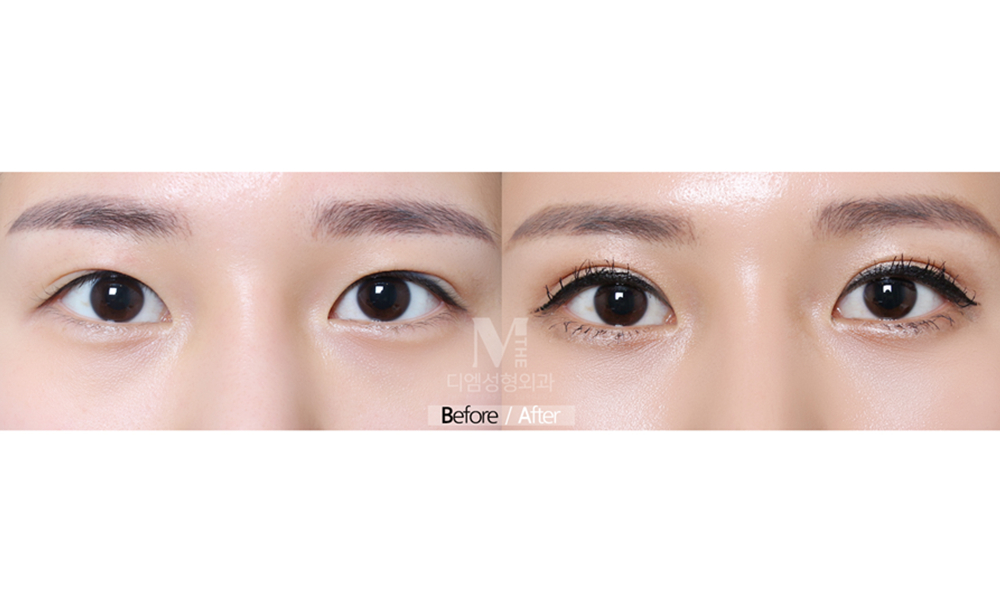 Double Eyelid Surgery